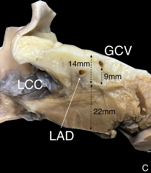 Left ventricular summit -- concept, anatomical description and